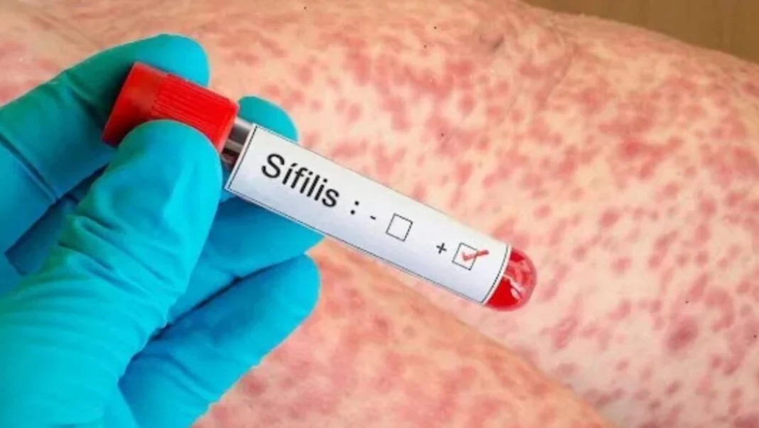 sifilis